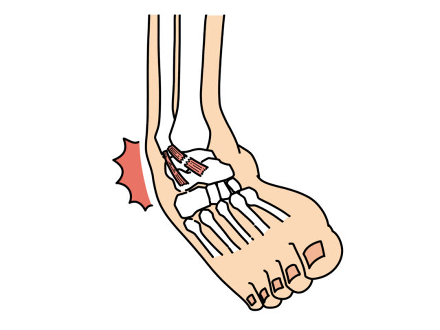 不意の捻挫や肉離れも安心｜喜多見の整骨院で早期回復へ